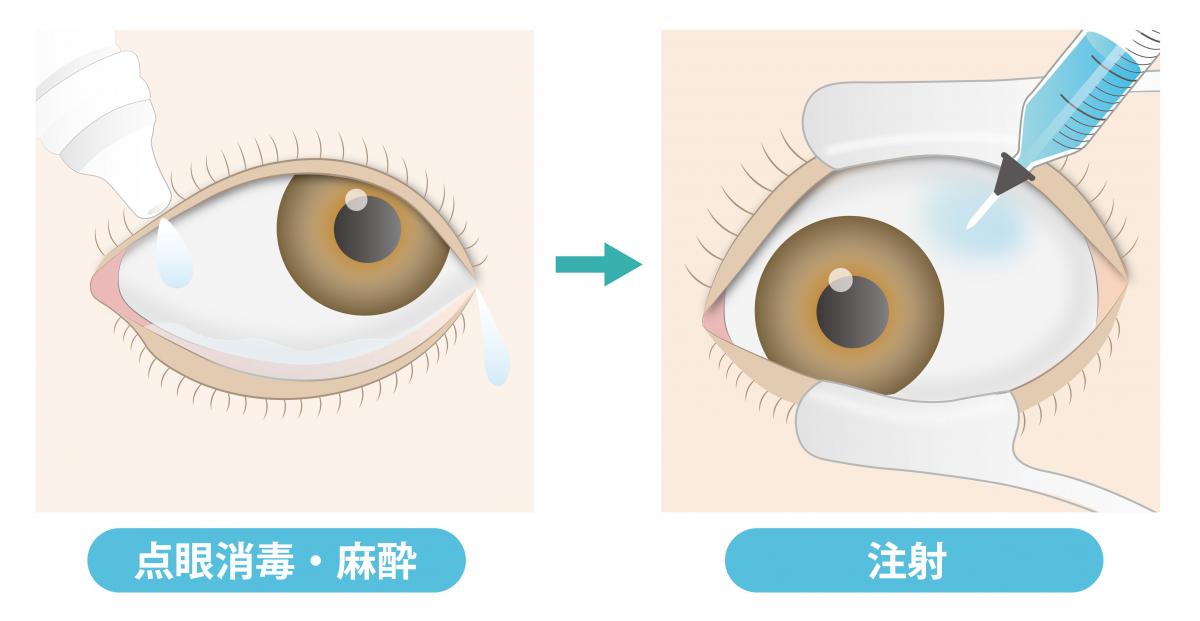 硝子体内注射について